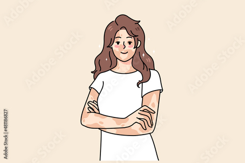 Smiling young woman with skin disease feel body positive. Happy girl on vitiligo international day. Depigmentation day. Skincare problem concept. Flat vector illustration. 