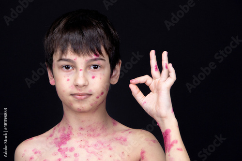 A boy aged 8 years old is gesturing OK. Chickenpox virus. Skin rash in a child. photo