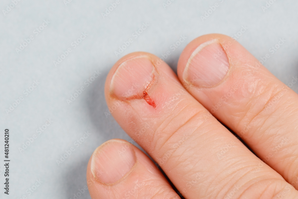 small-wound-on-the-finger-fresh-blood-after-injury-close-up-bleeding