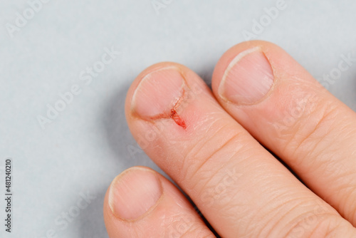 Small wound on the finger  fresh blood after injury  close up  bleeding
