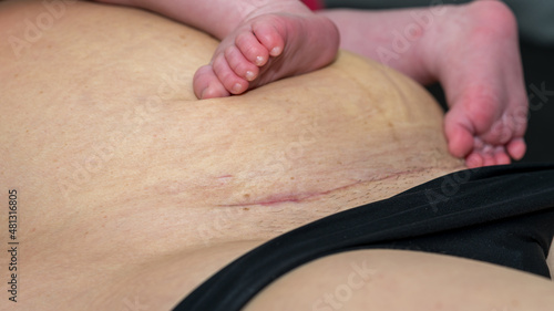 Closeup of a woman belly with a scar from a cesarean section with baby feet of the newborn on the belly