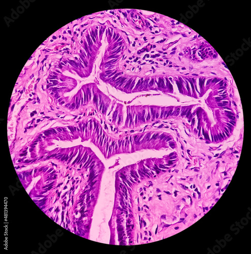 Chronic cholelithiasis of Gallbladder, microphotograph of chronic cholecystitis, show perimuscular fibrosis and infiltration of chronic inflammatory cells photo