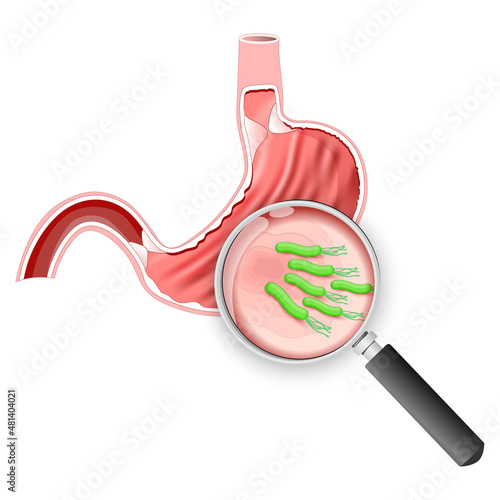 Helicobacter pylori. stomach with Peptic ulcer disease, and Magnifying glass.