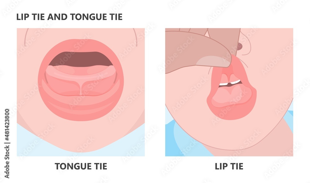 Best bottle teat for tongue hotsell tied baby