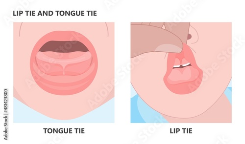 Tongue tie top lip bottle feeding sore damaged nipples issue care nurse Breast oral colic milk supply dentistry Torn frenuloplastika thrust frenulotomy frenulectomy nursery abnormal removal baby