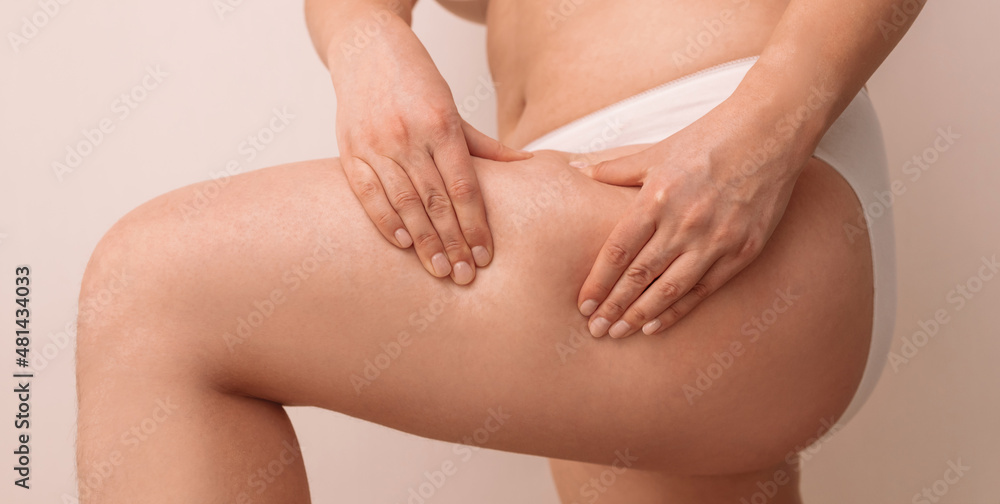 Fat woman with cellulites. Overweight woman with fat thighs Fat woman with cellulites. Overweight woman with fat thighs