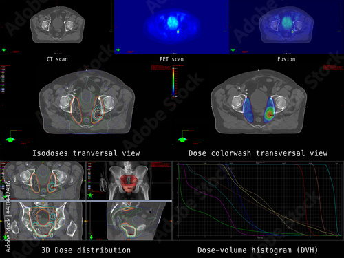 The overview shows CT and PET cross-sections of a patient with a malignant neoplasm of the prostate and pelvic lymph node involvement. Furthermore, the result of the calculation for radiation therapy.