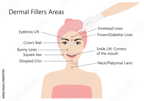 Dermal filler injections areas. Woman face with doctor hands in gloves with syringe. Beauty lifting anti-aging treatment vector illustration.
