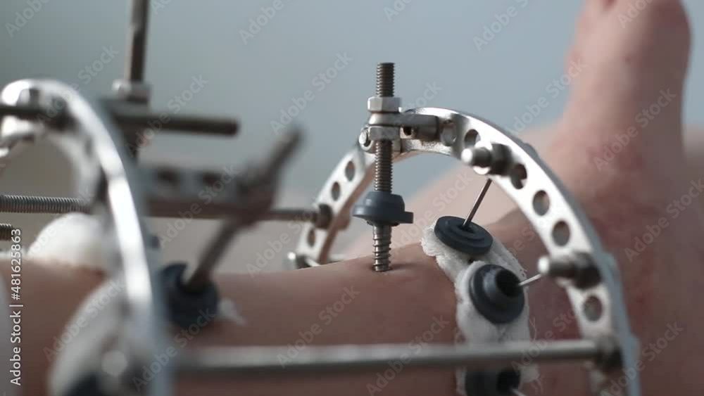 leg in Ilizarov's external fixator, Ilizarov's apparatus leg in Ilizarov's external fixator, Ilizarov's apparatus