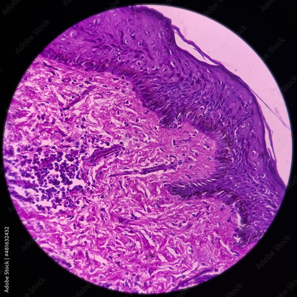 Scar endometriosis, microscopic image show fibrocollagenous tissue