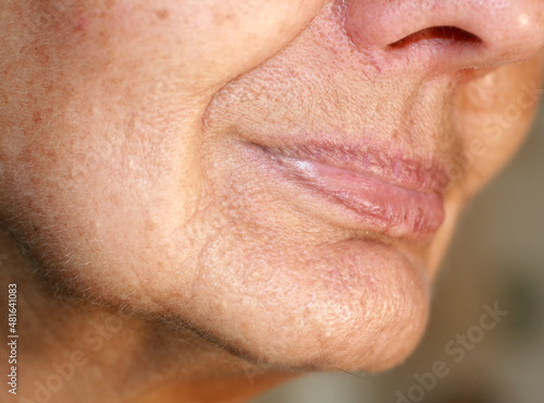 Flabbiness of the skin of the cheeks. Wrinkles on the face. Nasolabial wrinkles. photo