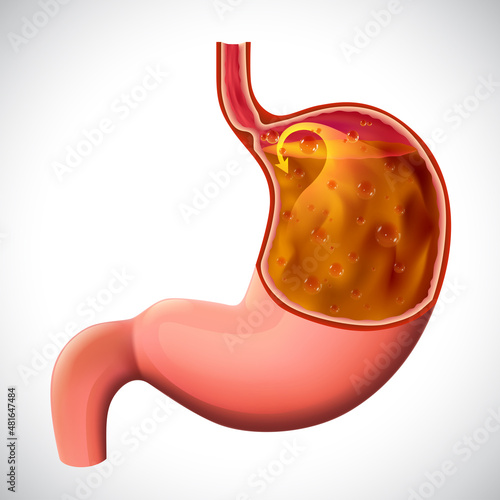 An illustration of a gastric reflux, dissected to show the inside, for medical and educational use.