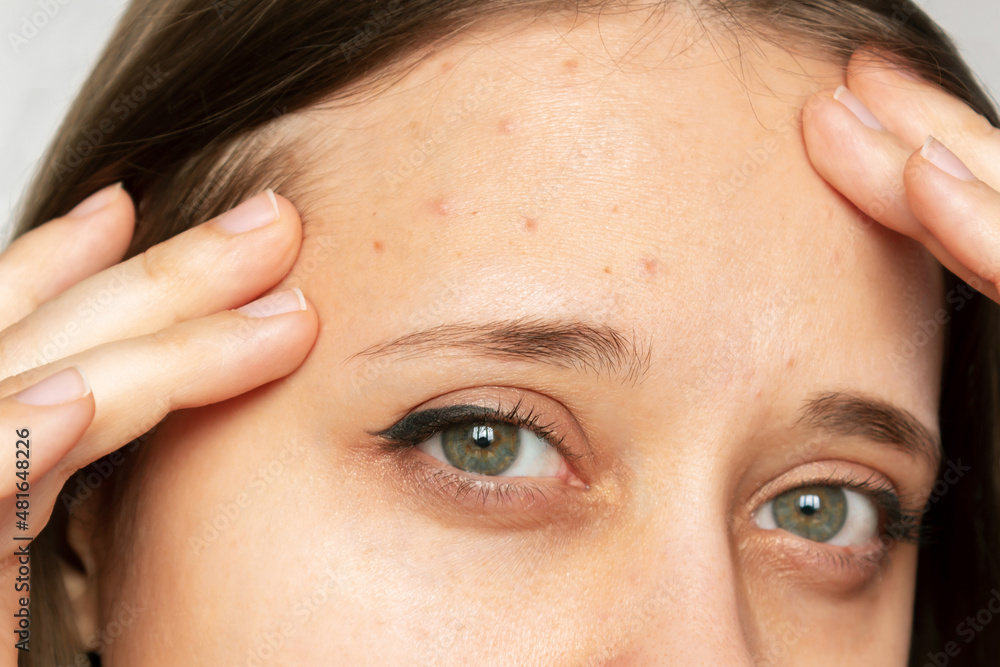 Cropped shot of a young woman's face with the problem of acne. Pimples on the forehead. Allergies, dermatitis, rash, hormonal changes. Problem skin, care and beauty concept. Dermatology, cosmetology Cropped shot of a young woman's face with the problem of acne. Pimples on the forehead. Allergies, dermatitis, rash, hormonal changes. Problem skin, care and beauty concept. Dermatology, cosmetology