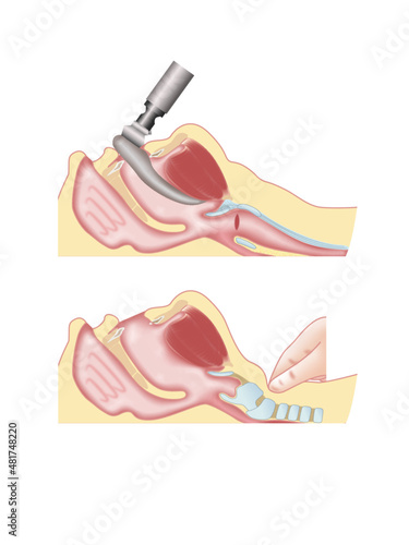 Endotracheal intubation