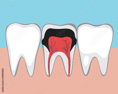 Tooth with caries, Flat vector stock illustration with Molar of an adult with pulpitis