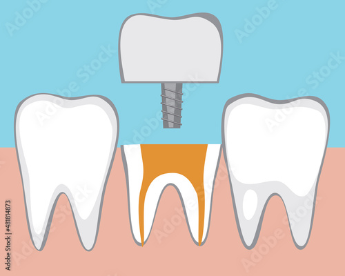 Ceramic tooth crown, Flat vector stock illustration with Orthodontic tooth restoration