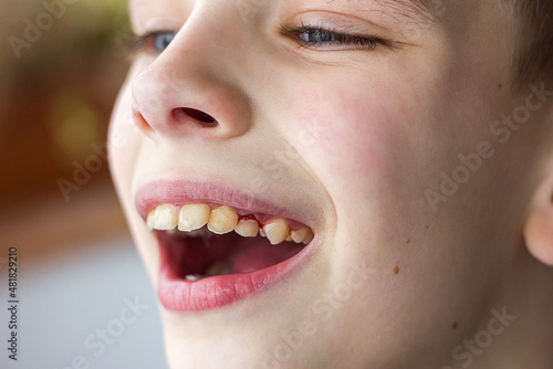 Unfocused face of boy with open mouth and blood on teeth  pediatric dentistry disease and dental and oral cavity treatment