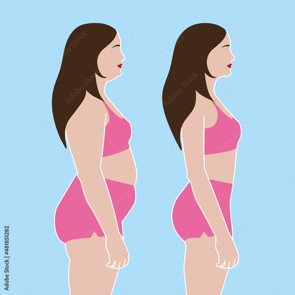 Before after view of a liposuction female body sculpture Before after view of a liposuction female body sculpture