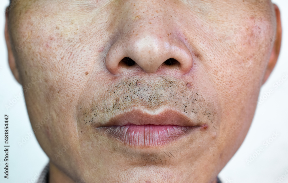 Rough skin in face of Asian, Myanmar or Korean man. Rough skin in face of Asian, Myanmar or Korean man.