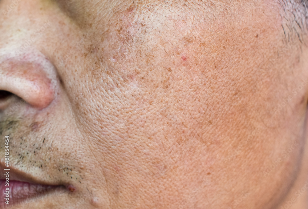 Wide pores at rough skin in face of Asian, Myanmar or Korean man.