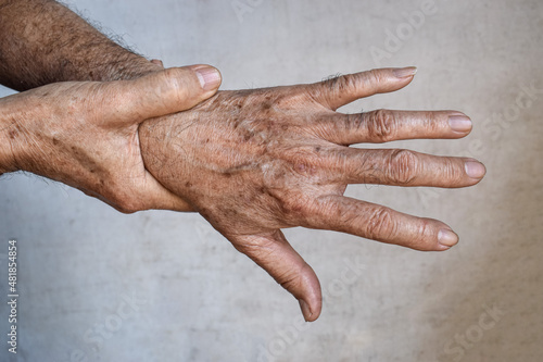 Foto Age spots on hands
