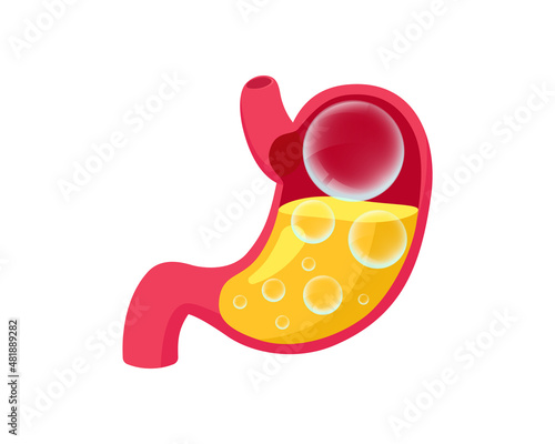 Bloated stomach with gases transparent balls inside. Digestive system bloating problem. Overeating indigestion and belly disease. Abdominal gastric pain medical vector eps illustration