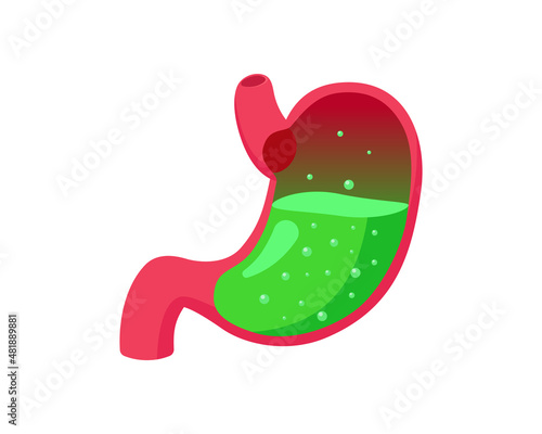 Stomach GERD or poisoning with green liquid acid inside. Gastroesophageal reflux belly disease. Digestive system heartburn problem. Nausea and indigestion. Abdominal gastric pain medical illustration