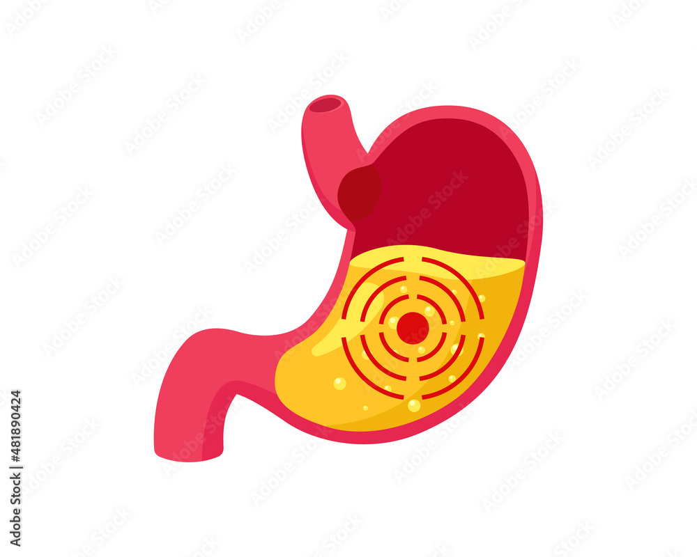 Stomach ulcer with gastric juice inside and target. Digestive system gastritis problem. Indigestion and belly disease. Abdominal gastric pain. Medical vector eps illustration Stomach ulcer with gastric juice inside and target. Digestive system gastritis problem. Indigestion and belly disease. Abdominal gastric pain. Medical vector eps illustration