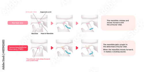 Comparison illustration of normal jaw and Temporomandibular disorders (TMD) photo
