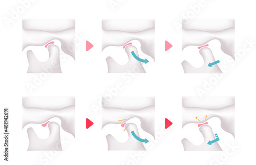 Comparison illustration of normal jaw and Temporomandibular disorders (TMD)