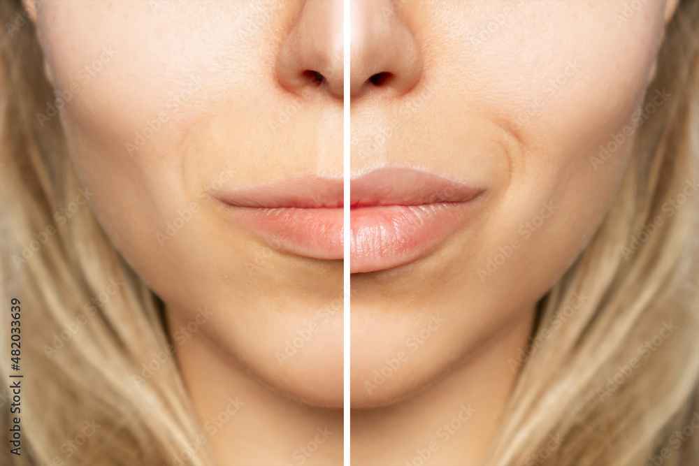 Cropped shot of young caucasian blonde woman's face with lips before and after lip enhancement. Injection of filler in lips. Lip augmentation. Close up