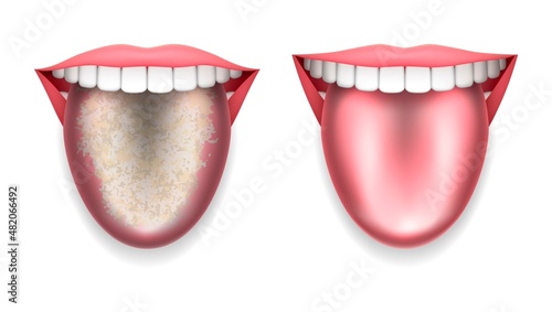 Open mouth with protruding tongue on a white background: with and without plaque