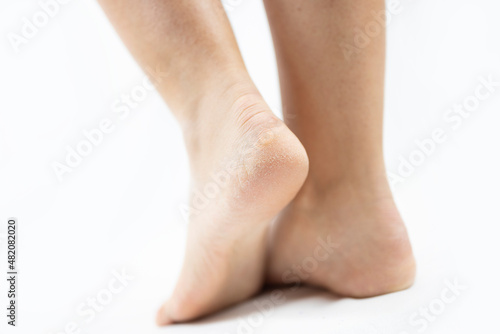 legs of an adult human girl with dry heels and cracked disease on a white background