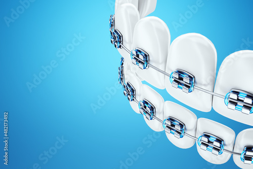 White teeth with metal braces on a blue background. Dental braces, orthodontic treatment, dentistry, teeth whitening, protection, oral care, hygiene, healthcare. 3D illustration, 3D render. photo