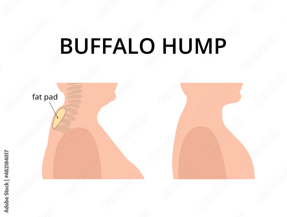Patient with buffalo hump with fat deposits around the vertebrae