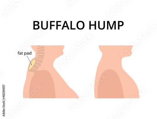 Patient with buffalo hump with fat deposits around the vertebrae. Dowager's hump, kyphosis, spine. For topics like post-menopause, osteoperosis, scoliosis  photo