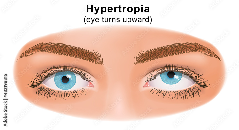 Squint eye (Strabismus). Hypertropia, eye turns upward. Deflection of  visual axes. Vector illustration. Stock Vector | Adobe Stock
