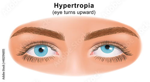 Squint eye (Strabismus). Hypertropia, eye turns upward. Deflection of visual axes. Vector illustration.