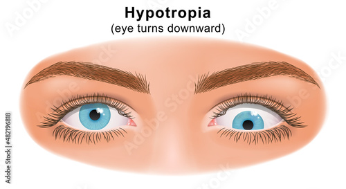 Squint eye (Strabismus). Hypotropia, eye turns upward. Deflection of visual axes. Vector illustration.