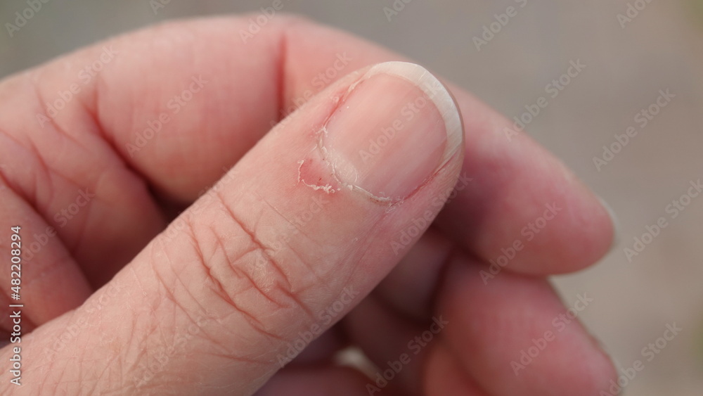 Close up of torn, ripped and picked on cuticle skin on a woman's thumb Close up of torn, ripped and picked on cuticle skin on a woman's thumb