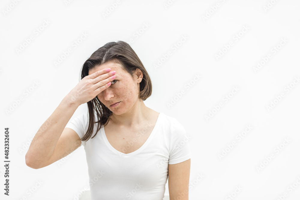 Photo of woman having skin problems and feeling bad because of it. Photo of woman having skin problems and feeling bad because of it.