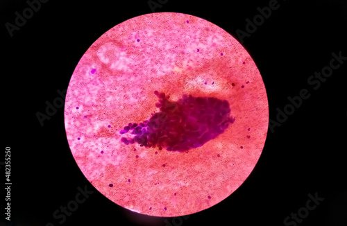 Metastatic adenocarcinoma of lung. Malignant effusion: Pleural fluid cytology of lung (pulmonary) papillary adenocarcinoma, a type of non small cell carcinoma. photo