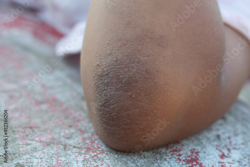 Dark patches on the skin and allergic rash at the child elbows known as acanthosis nigricans look like a darkened velvet.