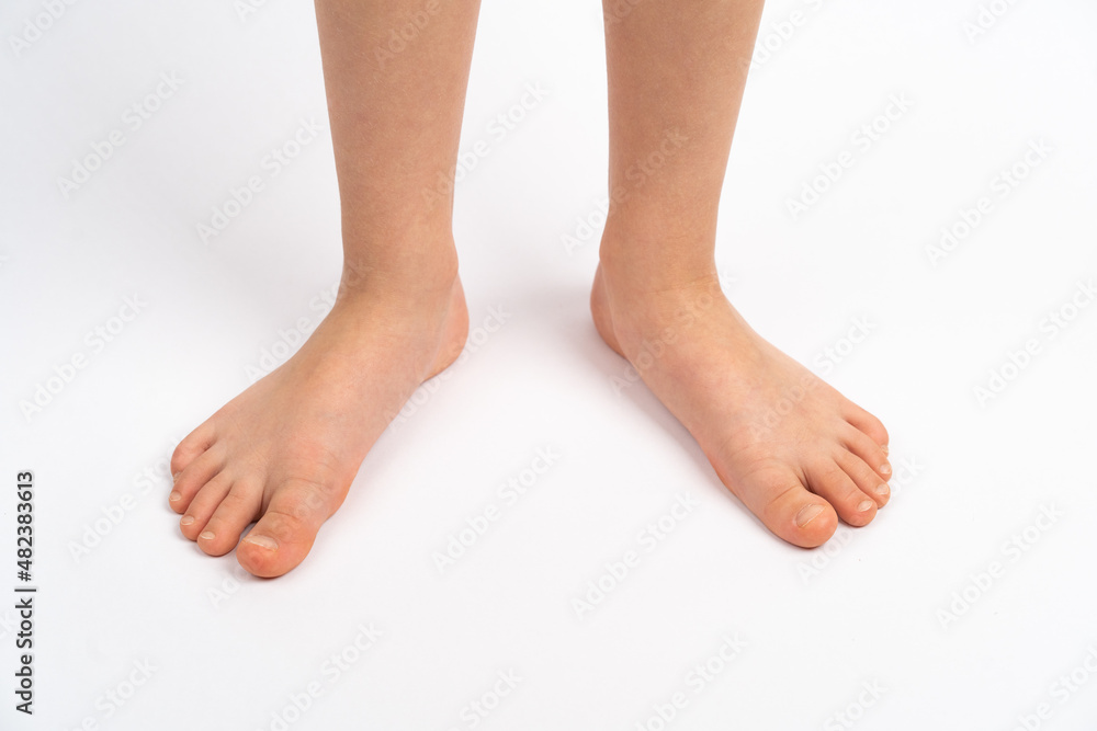 children's feet on a white background, the concept of prevention of children's flat feet, valgus of the foot