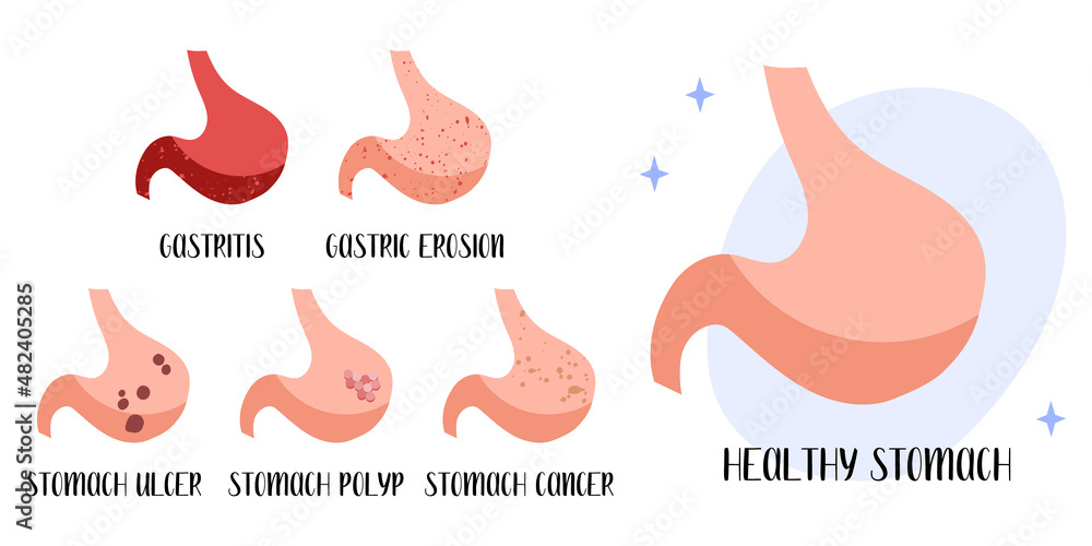Healthy stomach. Diseases: gastritis, gastric erosion, ulcer, cancer, polyp. Gastroenterology. Vector flat cartoon illustration. Perfect for medical flyer, brochure