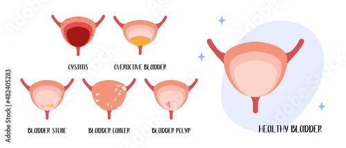 Healthy bladder. Diseases: cystitis, overactive bladder, stones, cancer, polyp. Urology. Vector flat cartoon illustration. Perfect for medical flyer, brochure