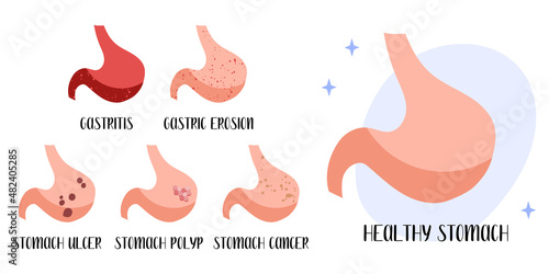 Healthy stomach. Diseases: gastritis, gastric erosion, ulcer, cancer, polyp. Gastroenterology. Vector flat cartoon illustration. Perfect for medical flyer, brochure