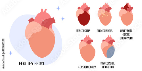 Healthy heart. Cardiovascular diseases: pericarditis, endocarditis, myocardial infarction, cardiomegaly, aneurysm. Cardiology. Vector flat cartoon illustration. Perfect for medical flyer, brochure