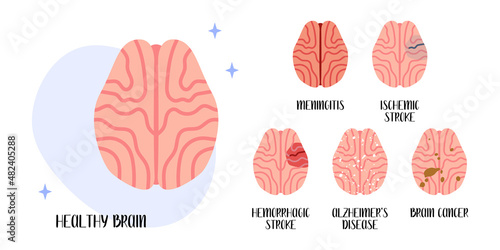 Healthy brain. Diseases: meningitis, ischemic and hemorrhagic stroke, alzheimer's disease, cancer. Neurobiology. Vector flat cartoon illustration. Perfect for medical flyer, brochure