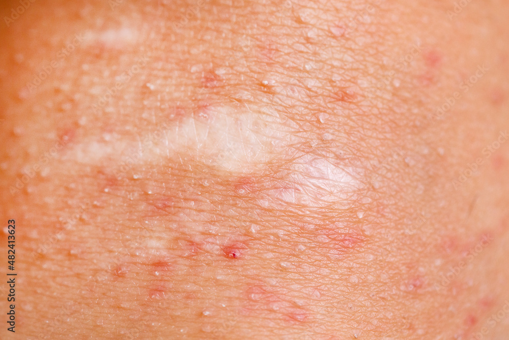 Wound on female knee, irritated skin Wound on female knee, irritated skin